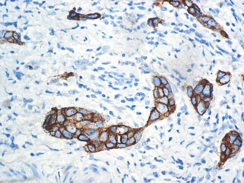 IHC of CA15-3 on an FFPE Breast Tissue